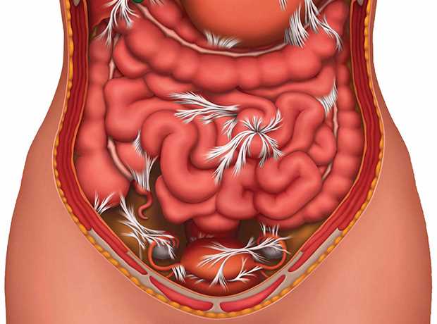 Последствия спаек после лапароскопии