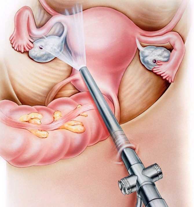 Что такое спайки после лапароскопии