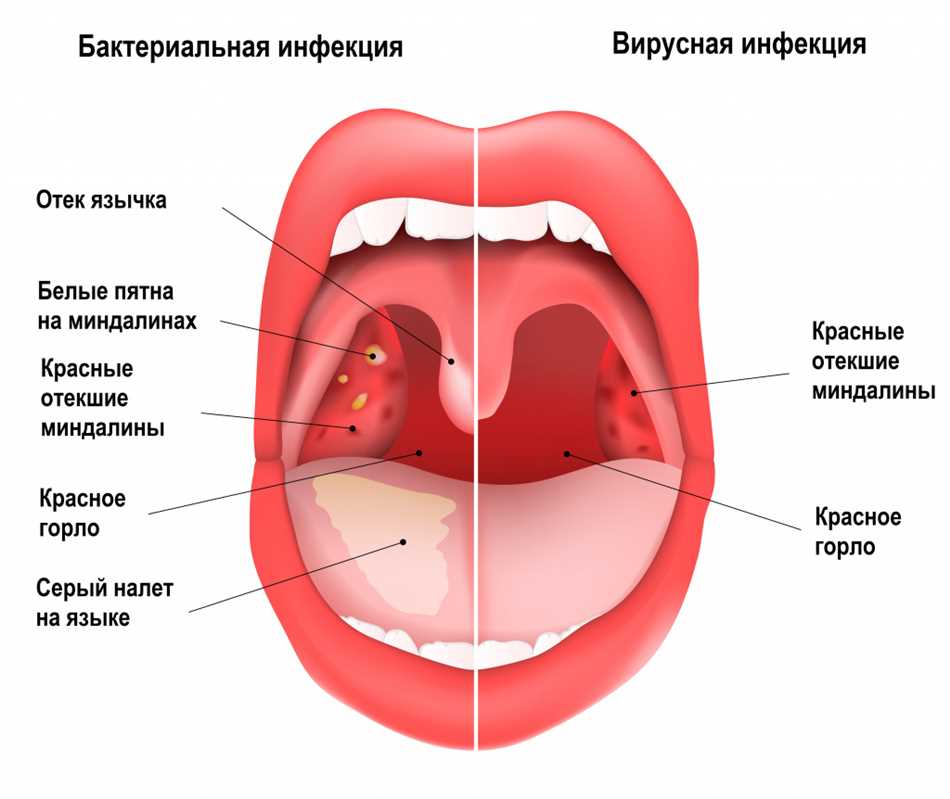 Какие симптомы обычно проявляются при стафилококковой ангине?