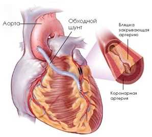 Что такое стэн в кардиологии и как его ставят