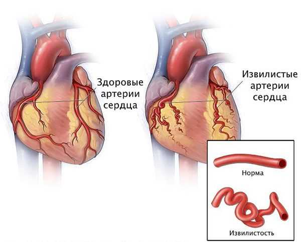 Симптомы стеноза сосудов сердца