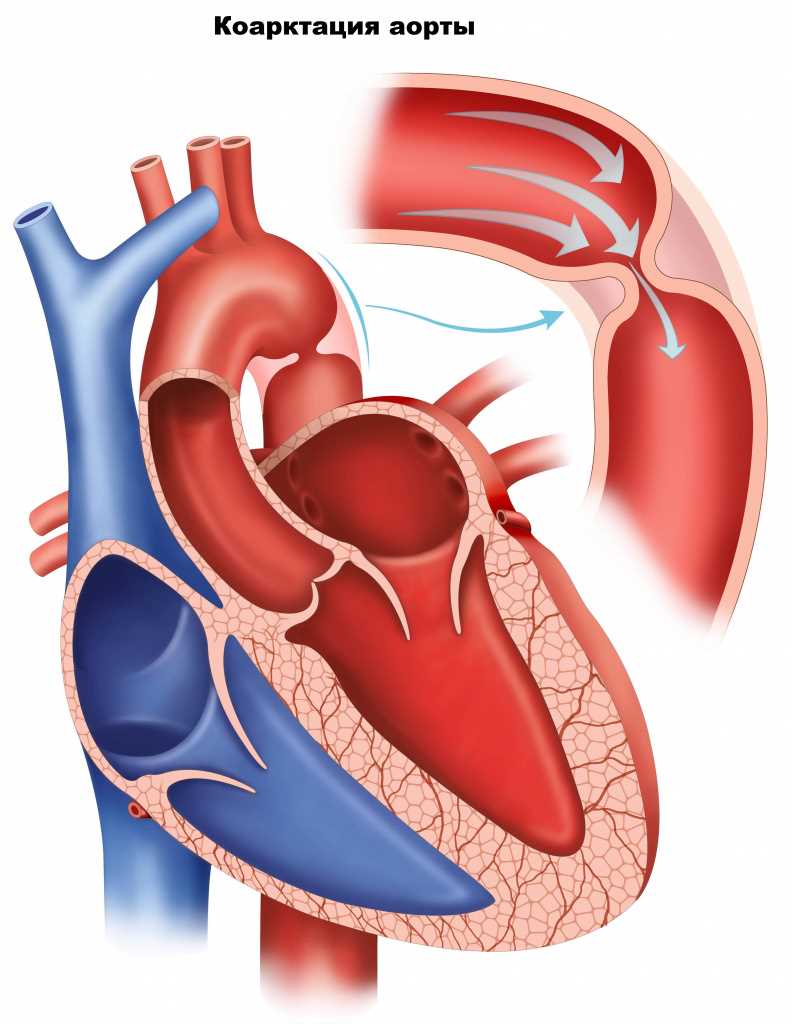 Диагностика и лечение стеноза сосудов сердца
