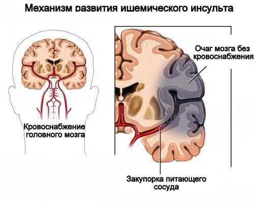 Профилактика стенозирующего атеросклероза