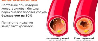 Что такое стенозирующий атеросклероз: причины, симптомы и лечение