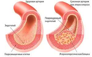 Причины стенозирующего атеросклероза