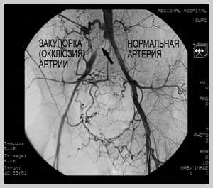 Лечение стенозирующего атеросклероза