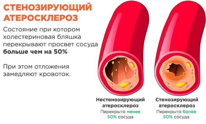 Что такое стенозирующий атеросклероз