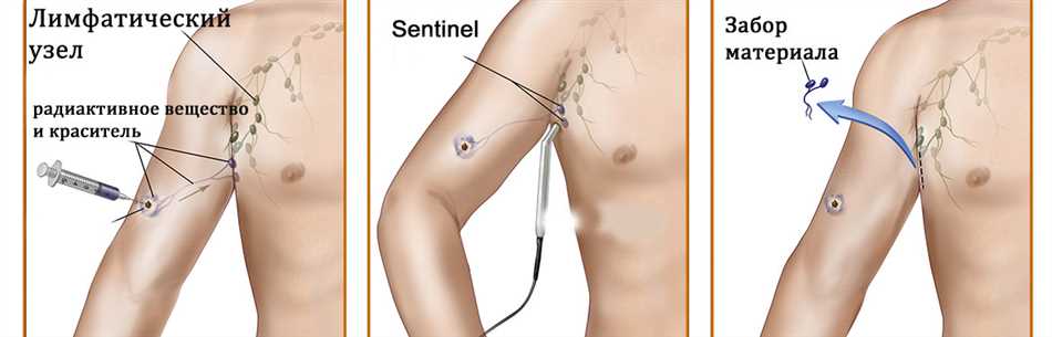 Техника проведения сторожевой лимфатической биопсии