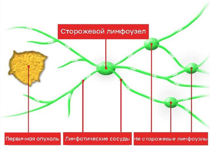 Структура и функции сторожевого лимфоузла