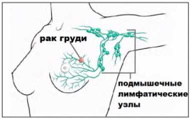 Что такое сторожевой лимфоузел