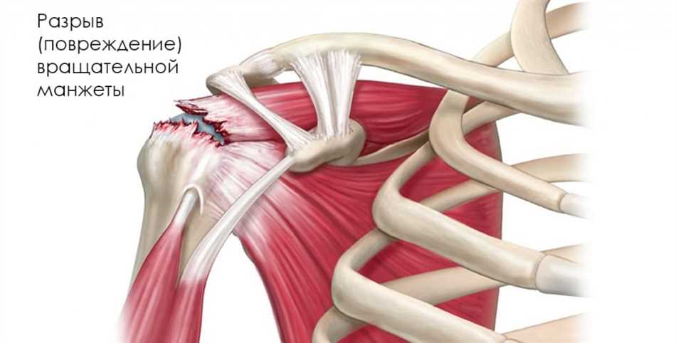 Субтотальный разрыв сухожилия