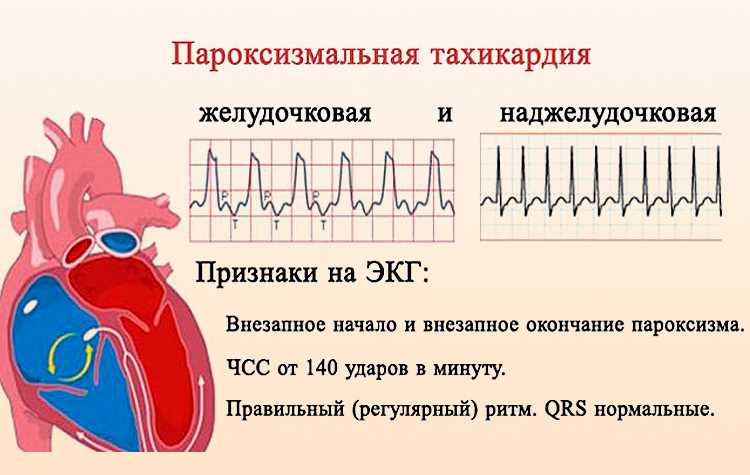 Тахикардия - официальный сайт