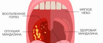 Тонзиллотомия и тонзиллэктомия: разница и показания к операции