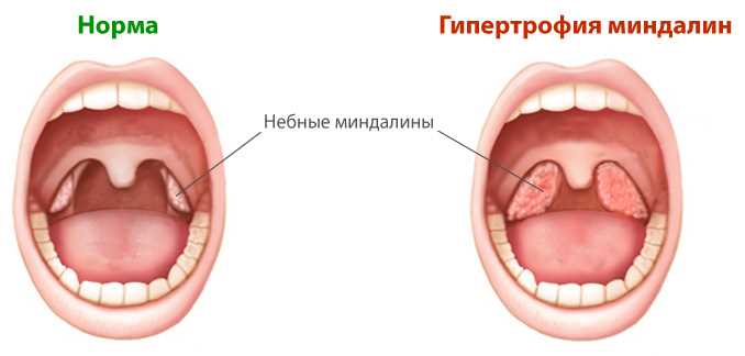 Тонзиллотомия