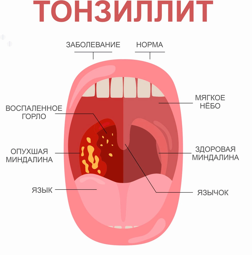 Что такое тонзиллотомия и тонзиллэктомия