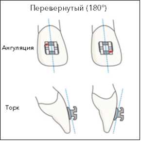 Что такое торк в ортодонтии