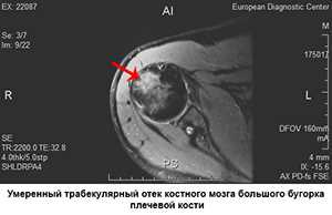 Что такое трабекулярный отек тазобедренного сустава?