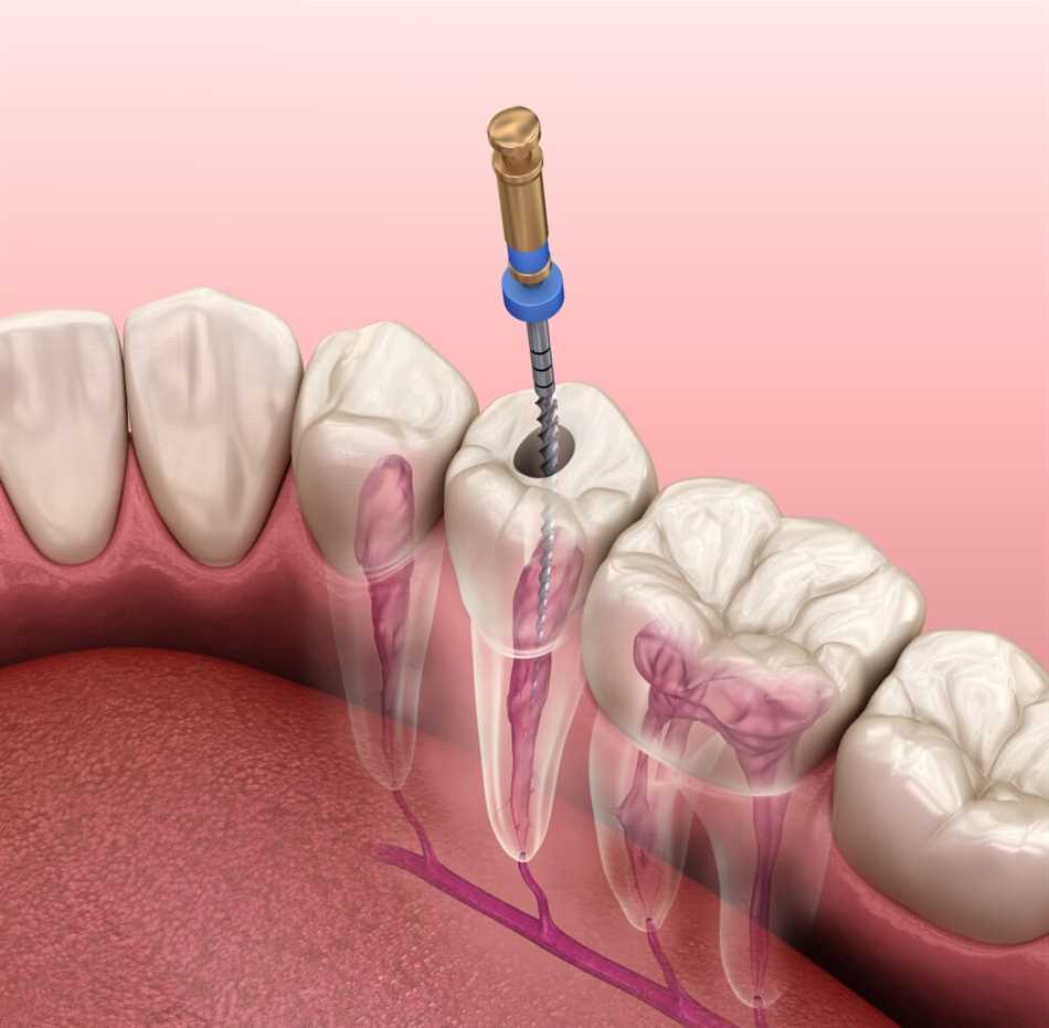 Что такое трепанация зуба искусственной коронки