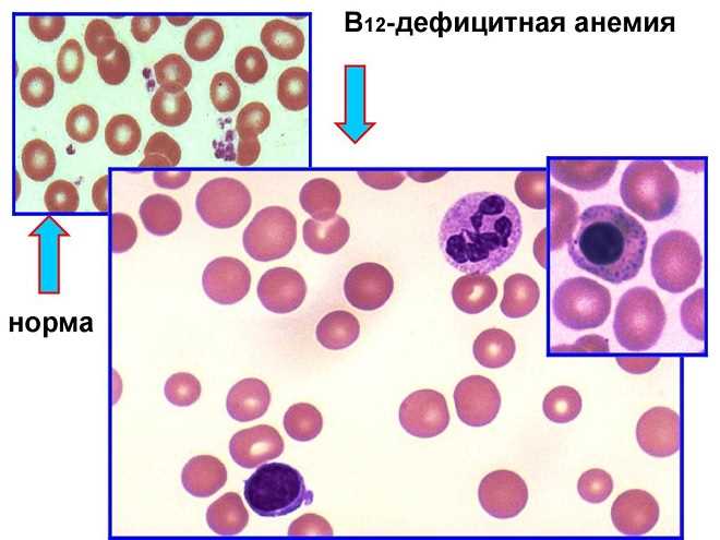 Симптомы злокачественной анемии