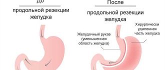 Что такое значительное снижение желудка?