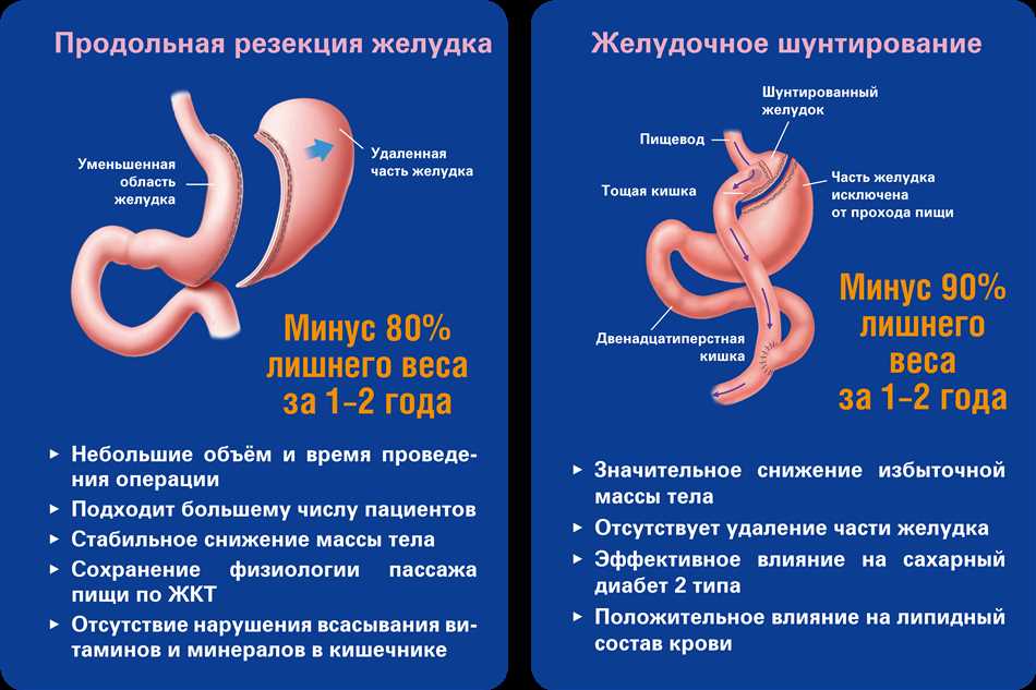 Диагностика значительного снижения желудка