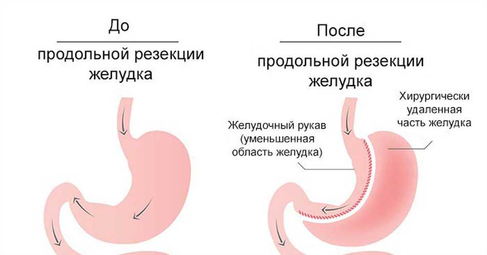 Что такое значительное снижение желудка?