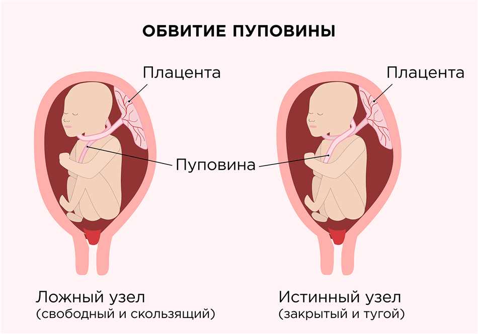 Причины двойного обвития пуповиной