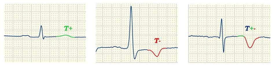 Возможные причины появления двухфазного зубца Т:
