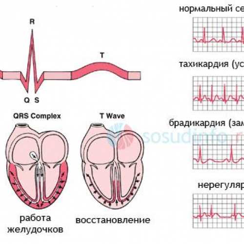 Что такое двухфазный зубец Т?