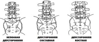 Двухсторонняя сакрализация L5 позвонка: понятное объяснение и особенности