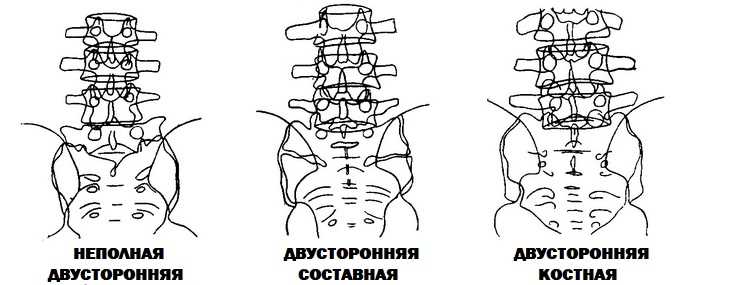 Двухсторонняя сакрализация L5 позвонка: что это такое?