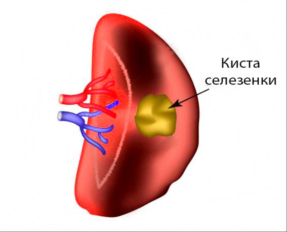 Опасности наличия двух селезенок у человека