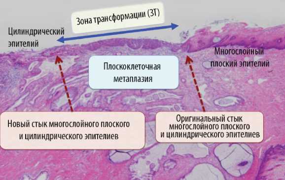 Возможные последствия отсутствия клеток зоны трансформации в цитологии