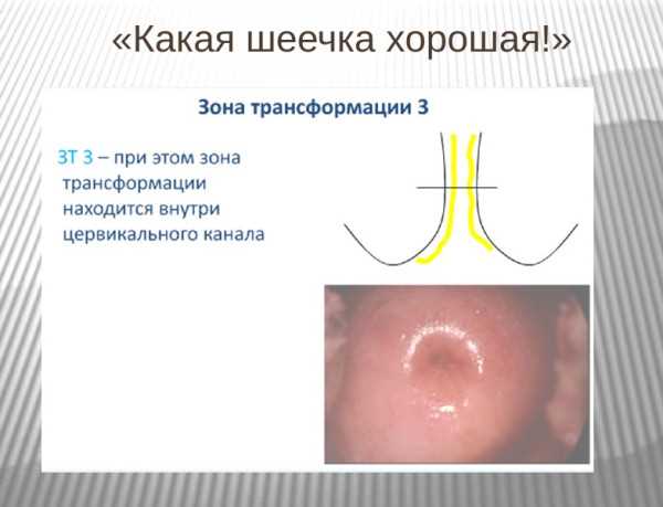 Причины отсутствия клеток зоны трансформации в цитологическом анализе