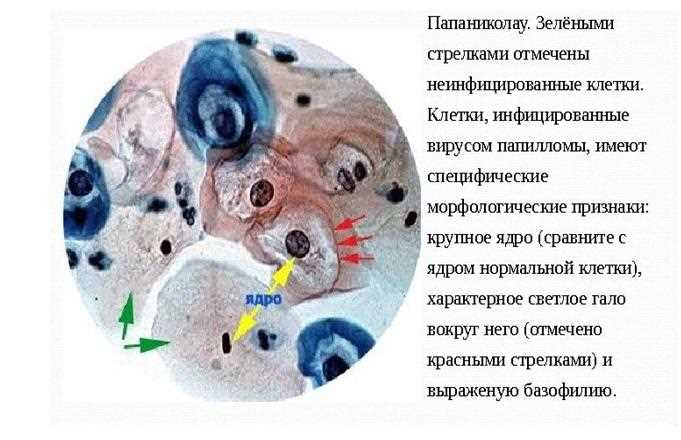 Отсутствие клеток зоны трансформации в цитологии: что это значит?