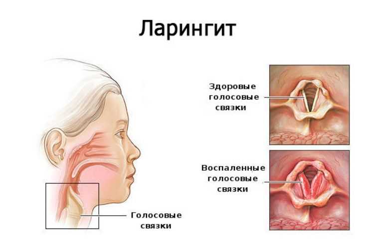 Звон или шум в ушах - Заболевания ушей, носа и горла - Справочник MSD Версия для потребителей