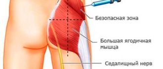 Боль в ноге после укола в ягодицу: как справиться?