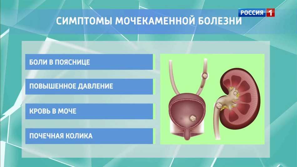 Причины двустороннего нефролитиаза