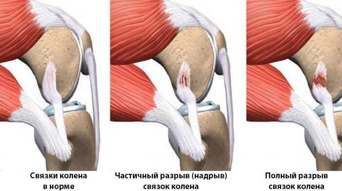 Симптомы растяжения передней большеберцовой мышцы