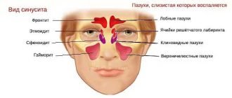 Риносинусит – симптомы, причины и лечение