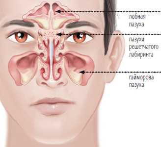 Риносинусит – что это такое в медицине?