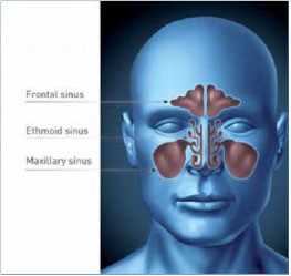 Риносинусит – что это такое?
