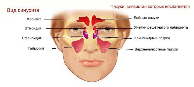 Риночинусит – что это такое в медицине?