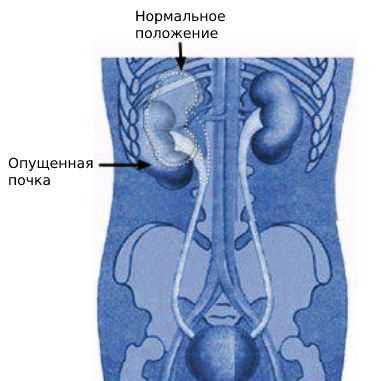 Ротация правой почки: что это такое?