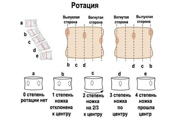 Ротация тел позвонков поясничного отдела: что это такое