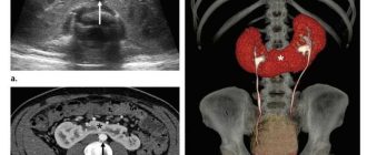 Ротирована почка: причины, симптомы и лечение