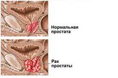 Диагностика ЗНО предстательной железы