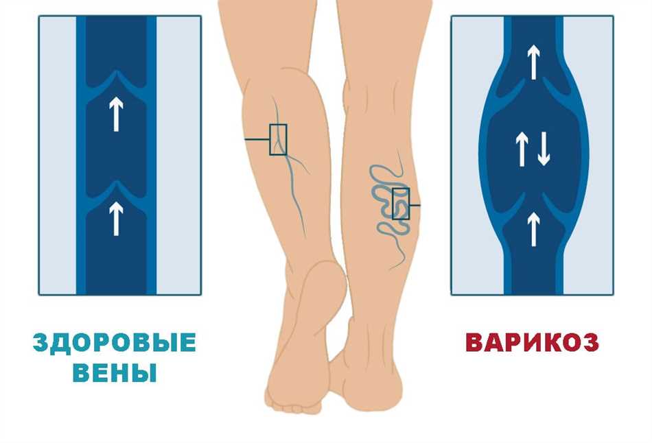 Симптомы и диагностика сафено-феморальной несостоятельности