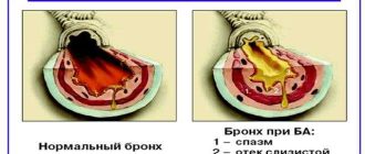 Санация бронхов: принципы и методы проведения