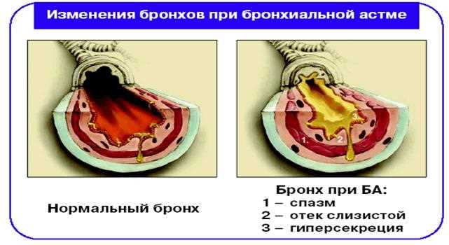 Санация бронхов: что это такое и каким образом проводится